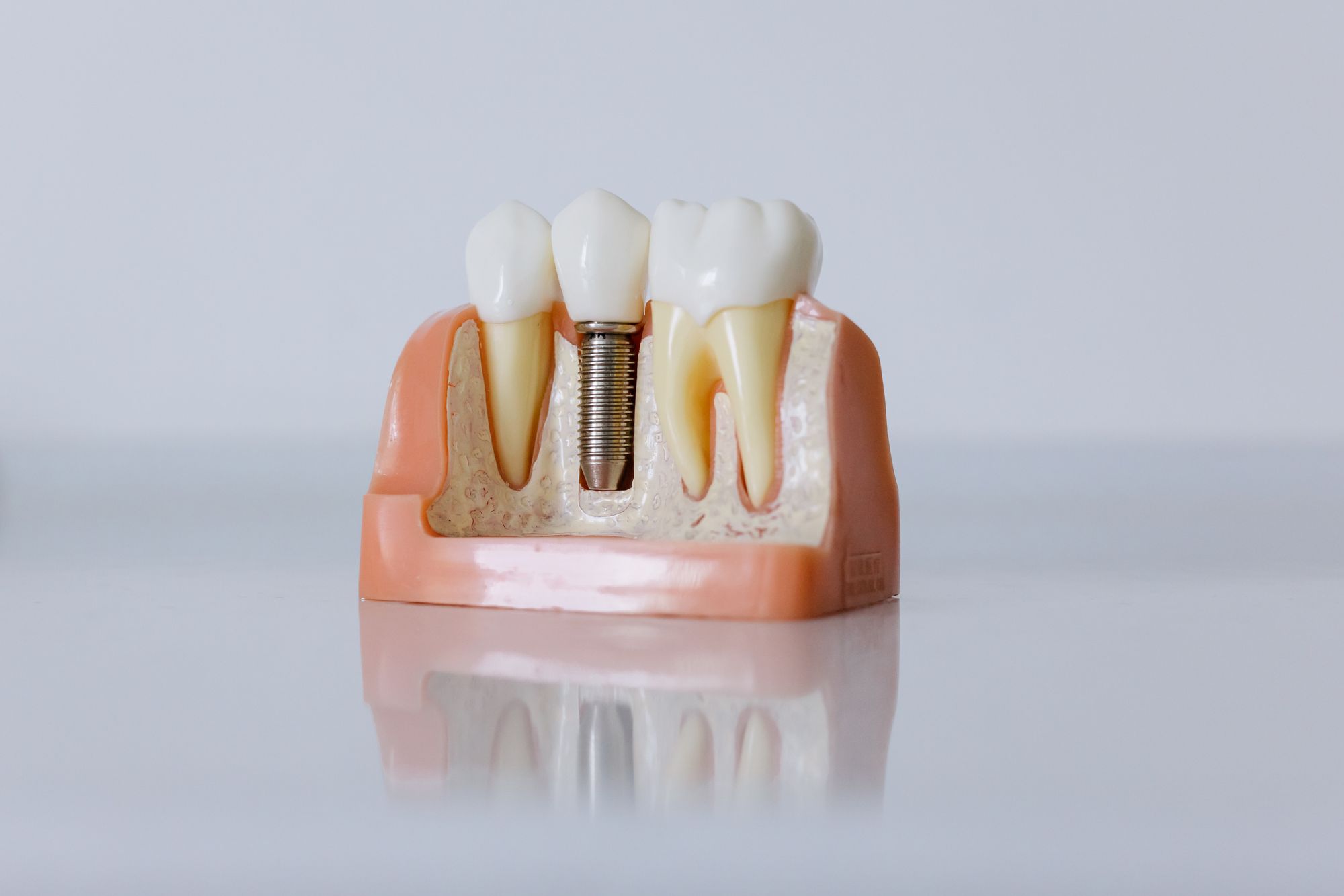Model de implant dentar